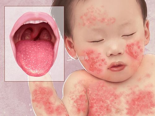 得了婴儿湿疹严重了会怎么样 得了婴儿湿疹严重了会怎么样