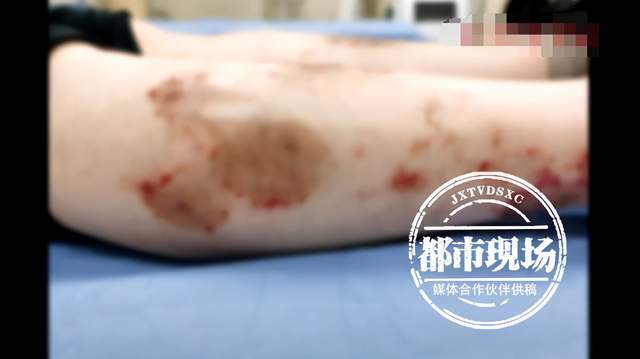 检查疱疹挂什么科 检查疱疹挂什么科