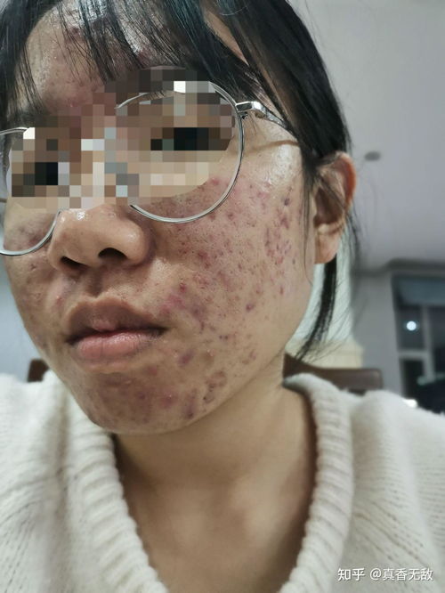 什么原因导致灰指甲复发 什么原因导致灰指甲复发