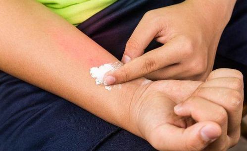 济南治疗银屑病哪家好 济南牛皮癣的治疗陷阱 济南治疗银屑病哪家好 济南牛皮癣的治疗陷阱