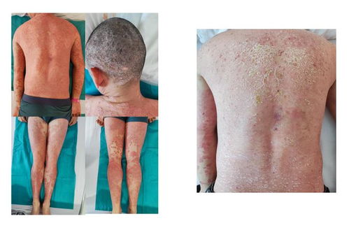 郑州治疗湿疹的专科医院 郑州治疗湿疹的专科医院