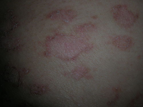 保定牛皮癣治疗怎么样 有效治疗牛皮癣的方法是什么 保定牛皮癣治疗怎么样 有效治疗牛皮癣的方法是什么