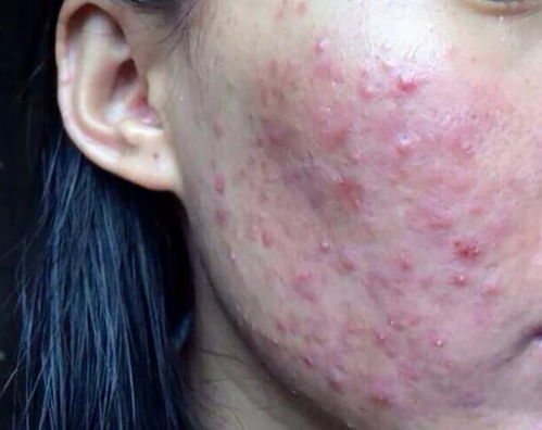 外阴旁边长了个囊肿是怎么回事 外阴旁边长了个囊肿是怎么回事