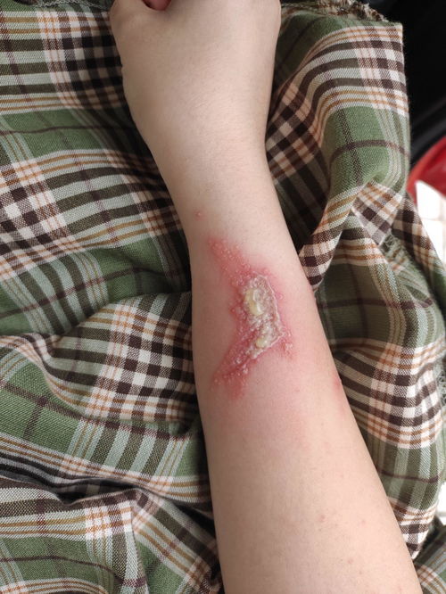脚趾染上了灰指甲该咋办 脚趾染上了灰指甲该咋办