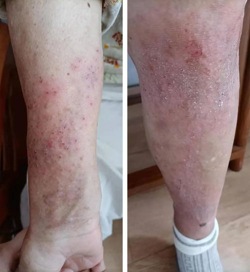 Ԥ����ָ�׸����Ĵ�ʩ����Щ