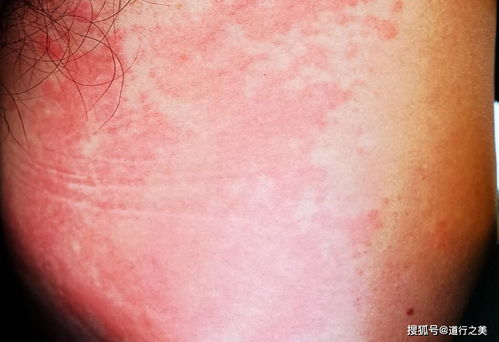 灰指甲症状表现 颜色变化增厚变形等特征概览 灰指甲症状表现 颜色变化增厚变形等特征概览