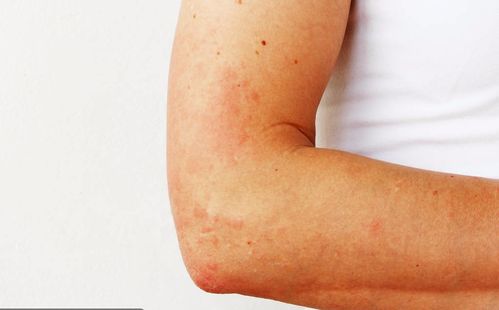 孕妇过敏起疙瘩用什么药 孕妇过敏起疙瘩用什么药