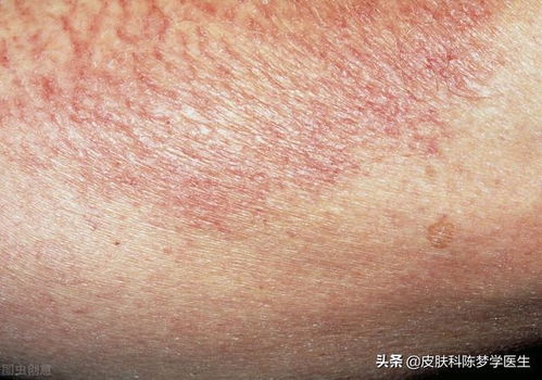 如何去判断是否患上灰指甲呢 如何去判断是否患上灰指甲呢