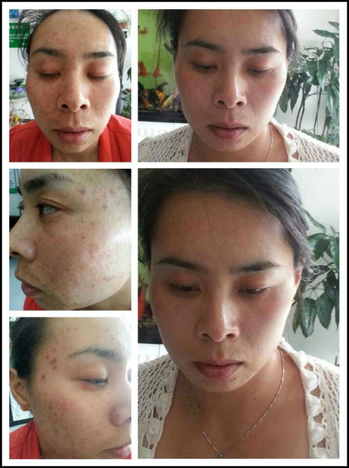 造成急性荨麻疹的病因 造成急性荨麻疹的病因