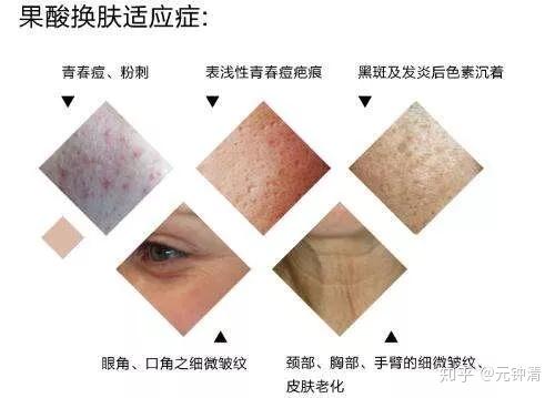 湿疹应怎么护理 湿疹应怎么护理