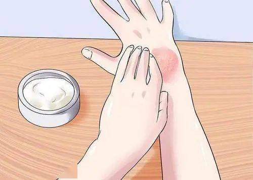 夏季预防痤疮事项 夏季预防痤疮事项