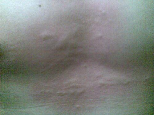 年轻人高血压能好吗 年轻人高血压能好吗