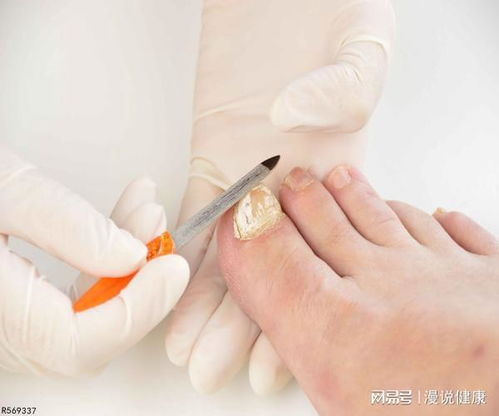 漳州治疗痤疮医院哪家正规 漳州治疗痤疮医院哪家正规