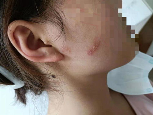 灰指甲会有什么影响 灰指甲会有什么影响