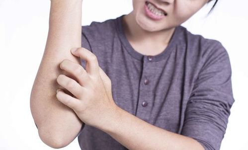 手足湿疹与手足癣如何鉴别 手足湿疹与手足癣如何鉴别