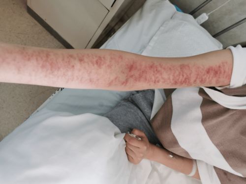 孕妇丘疹性荨麻疹怎么样治疗 孕妇丘疹性荨麻疹怎么样治疗