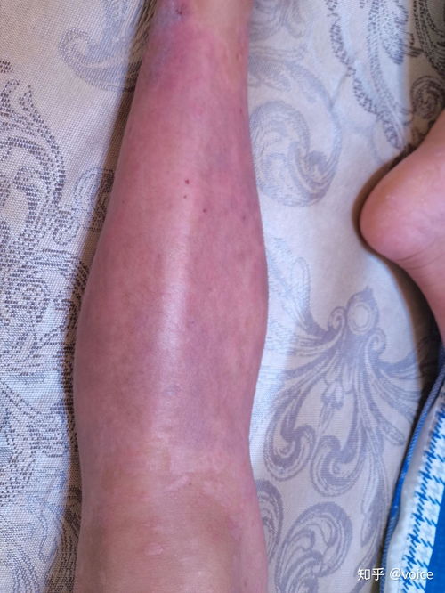 初期牛皮癣如何治疗 初期牛皮癣如何治疗