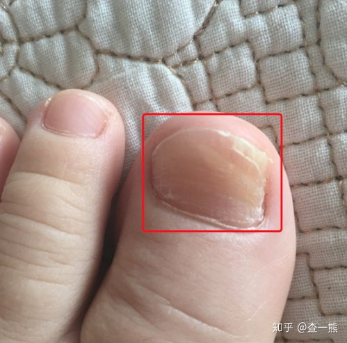 四种比较常见的灰指甲的分型 四种比较常见的灰指甲的分型