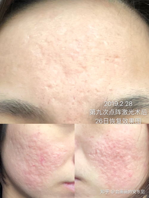 怎样治疗灰指甲才好 分享六种灰指甲的外用涂法 怎样治疗灰指甲才好 分享六种灰指甲的外用涂法