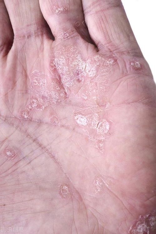 ��ָ�׵�ԭ����ʲô