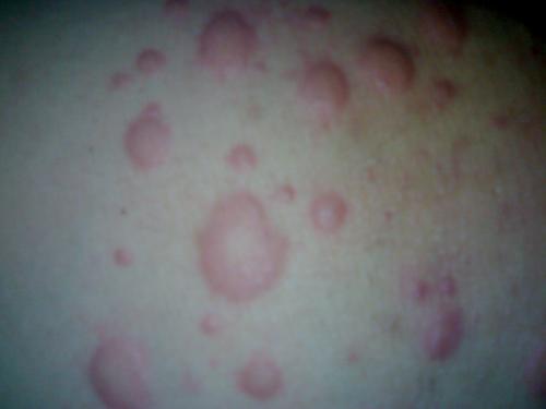 灰指甲应该怎样预防 灰指甲应该怎样预防