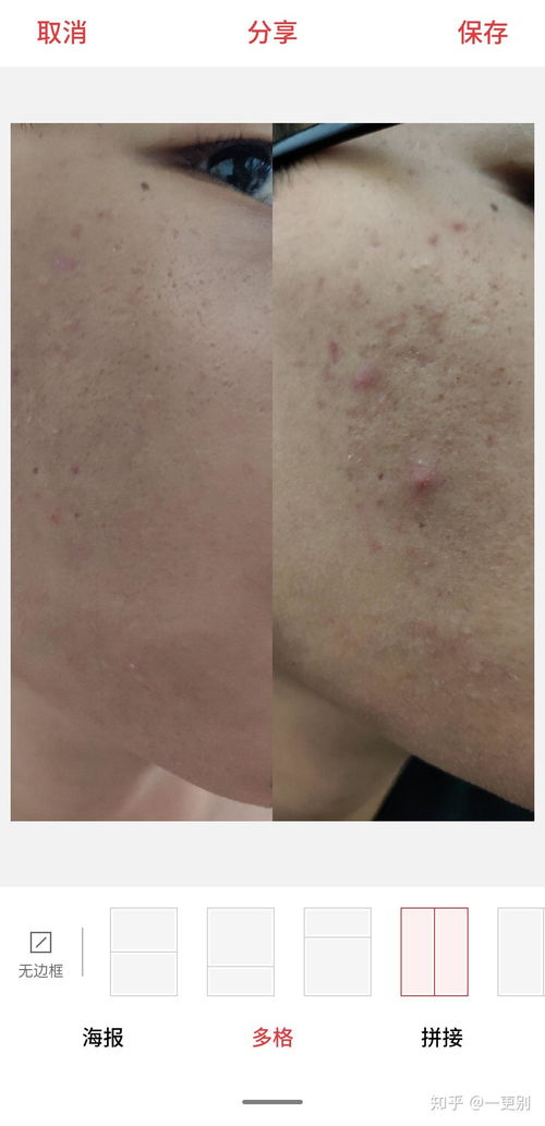 早期灰指甲怎么治 早期灰指甲怎么治