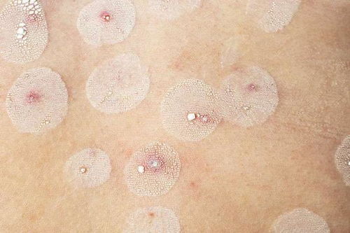 引起灰指甲的原因有哪些 引起灰指甲的原因有哪些