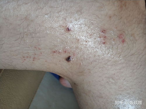 黑眼圈一直有什么原因引起的 黑眼圈一直有什么原因引起的