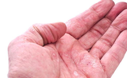 荨麻疹要吃啥药呢 荨麻疹要吃啥药呢