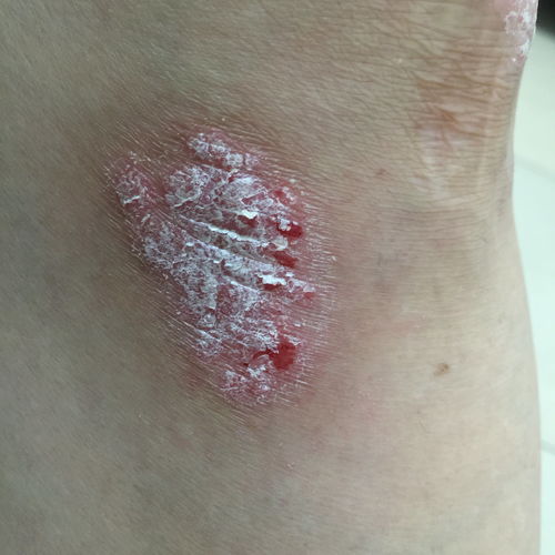 前列腺肥大会引起尿毒症吗 前列腺肥大会引起尿毒症吗