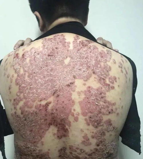 北海牛皮癣哪里治果好 北海牛皮癣哪里治果好