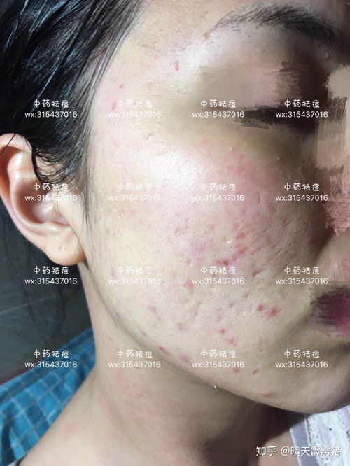 头皮屑多是由什么引起的 头皮屑多是由什么引起的