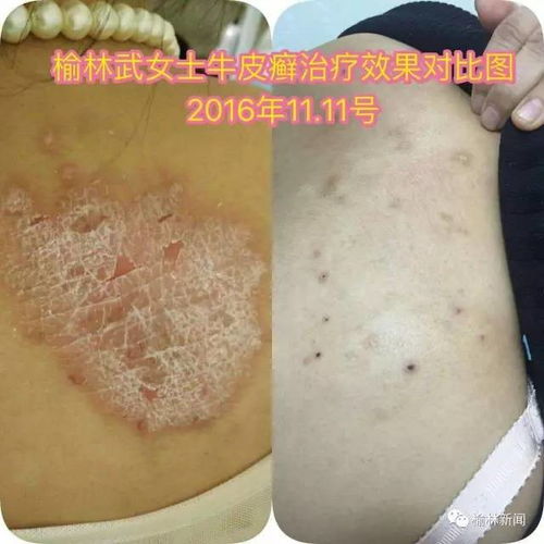 荨麻疹患者禁忌事宜 荨麻疹患者禁忌事宜