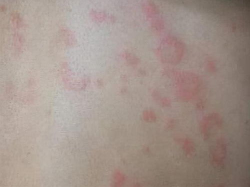 小孩荨麻疹能不能洗澡 哪种情况下可以洗澡 小孩荨麻疹能不能洗澡 哪种情况下可以洗澡