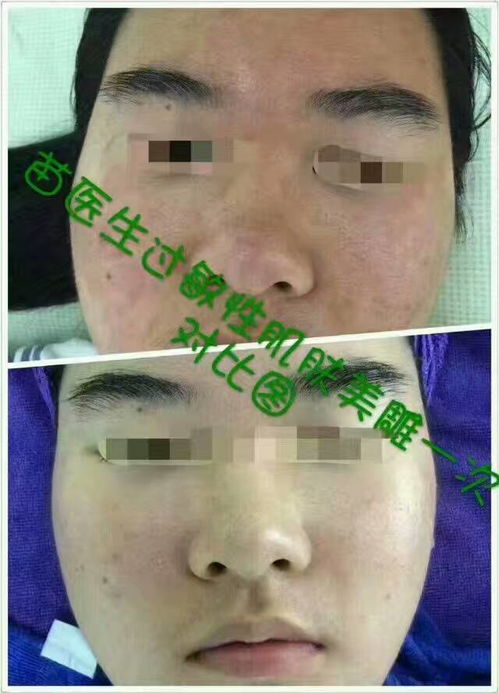寒湿性荨麻疹怎么治疗 寒湿性荨麻疹怎么治疗