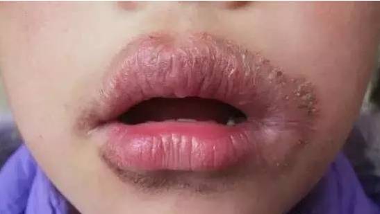 患有灰指甲如何治疗 患有灰指甲如何治疗