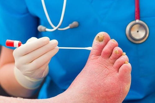 产后湿疹的原因是什么 产后湿疹的原因是什么