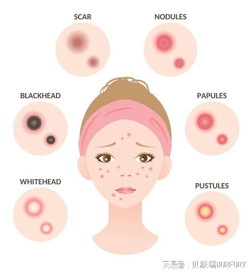 灰指甲患者日常如何护理 灰指甲患者日常如何护理