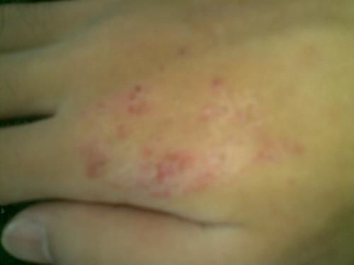 哪种花治脚气 哪种花治脚气