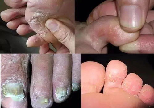 泰国青草膏可以治脚气吗 泰国青草膏对脚气管用吗 泰国青草膏可以治脚气吗 泰国青草膏对脚气管用吗