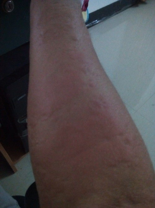 不同的脚气类型选择不同的治疗食物 不同的脚气类型选择不同的治疗食物