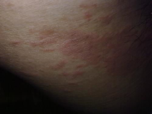 女性患了灰指甲会妇科病吗 女性患了灰指甲会妇科病吗