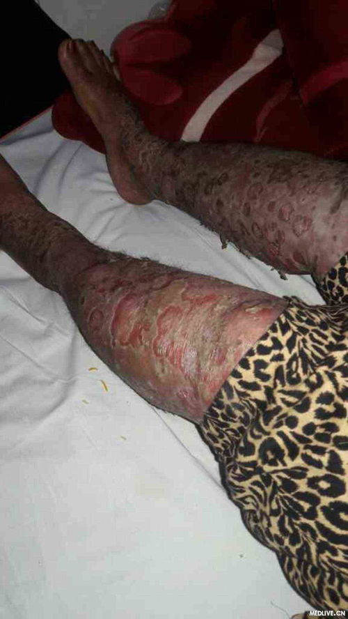 治疗灰指甲5款外用偏方 治疗灰指甲5款外用偏方