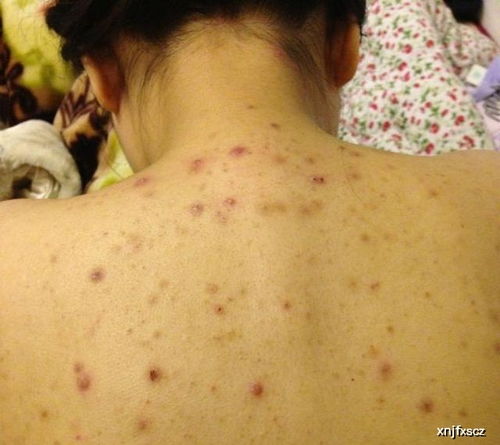 患了荨麻疹有哪些危害 患了荨麻疹有哪些危害