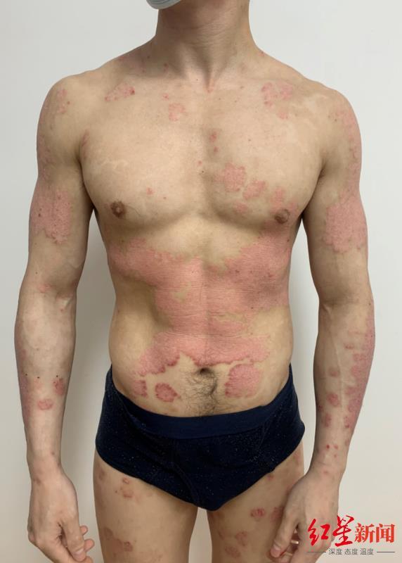 水泡型脚气的治疗方法有哪些 水泡型脚气的治疗方法有哪些