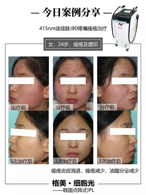 阻碍荨麻疹治愈的原因是什么 阻碍荨麻疹治愈的原因是什么