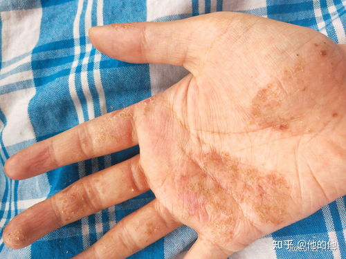 小儿荨麻疹快速消退方法 小儿荨麻疹快速消退方法