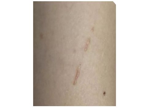 灰指甲最怕三个克星你知道吗 灰指甲在还是蛮普 灰指甲最怕三个克星你知道吗 灰指甲在还是蛮普