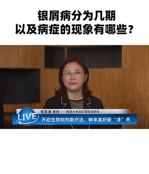 沈阳尖锐湿疹治疗的好方法有哪些 沈阳尖锐湿疹治疗的好方法有哪些