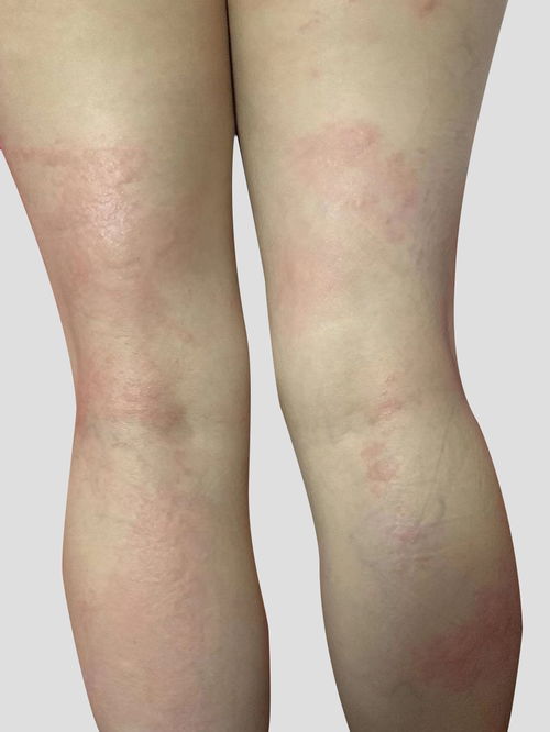 成人荨麻疹的症状和治疗 成人荨麻疹的症状和治疗